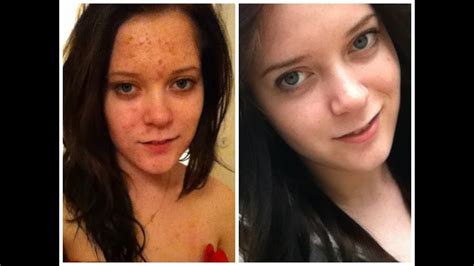 Before After Accutane | before after