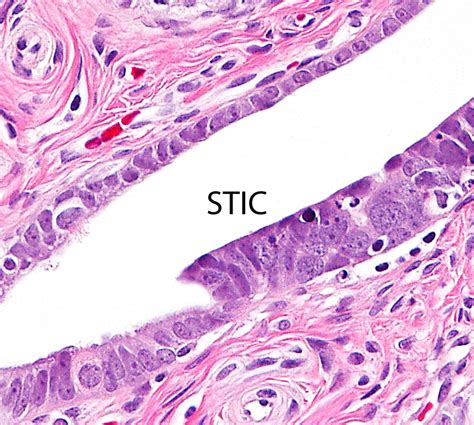 Serous tubal intraepithelial carcinoma - Libre Pathology