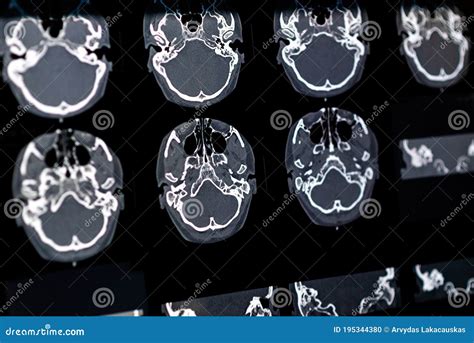 Brain CT Scan X-ray Film Image Brain Stock Photo - Image of health, basal: 195344380