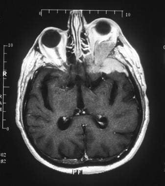 Optic Nerve Meningioma Mri