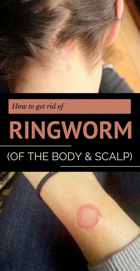 How to Get Rid of Ringworm (of the Body and Scalp) | Get rid of ...