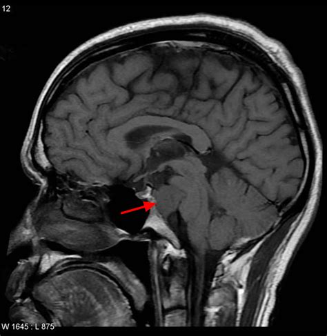 Chordoma Cancer - Causes, Symptoms, Life Expectancy, Treatment