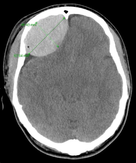 Cureus | Trauma-induced Acute Epidural Hematoma: The Rising Sun in a ...