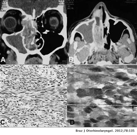 Malignant paranasal sinus schwannoma | Brazilian Journal of Otorhinolaryngology (English Edition)
