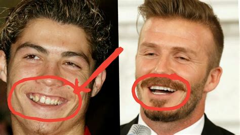 Celebrities With Braces Before And After, Metal Mouth Throwback Photos Of Celebs Before After ...