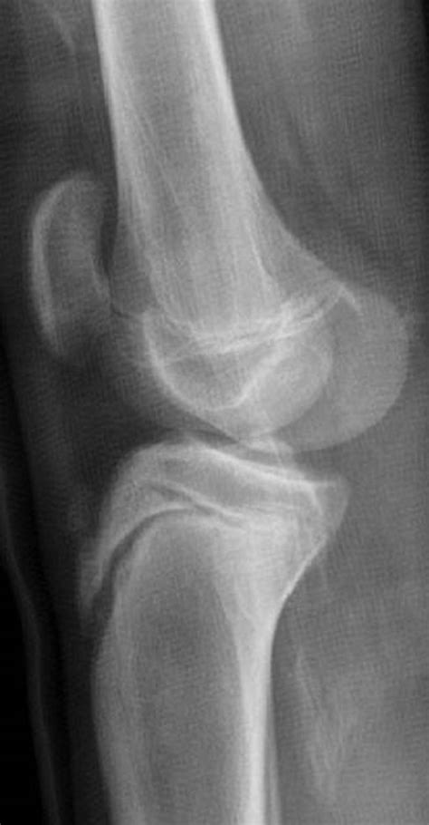 Imaging Review of Adolescent Tibial Tuberosity Fractures