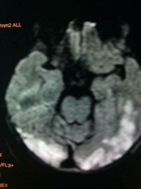 Platybasia with occipitalization of atlas and atlantoaxial dislocation !# basilar artery ...