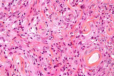 Meningioma - Oncology - Medbullets Step 2/3