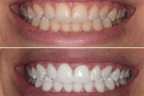 Professional Teeth Whitening 11235 Archives - Eco Dental NY - Best Dentist