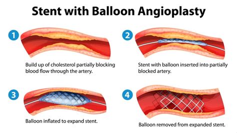 Coronary Artery Stenting | Houston Cardiovascular Institute