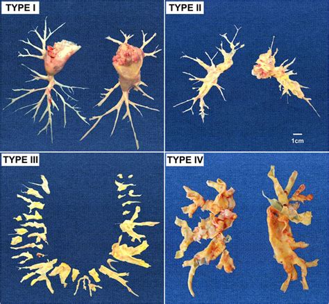 Update on Chronic Thromboembolic Pulmonary Hypertension | Circulation