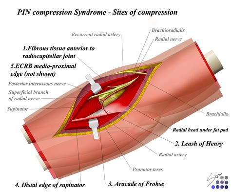 Orthobullets - "Radial tunnel syndrome is a compressive... | Facebook