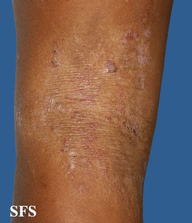 Atopic Dermatitis Causes, Pictures, Treatment, Diet | Healthhype.com