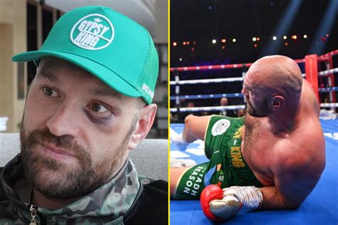 Tyson Fury shows off massive black eye as he claims he only lost two ...