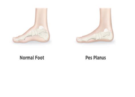 What is Pes Planus? – OrthoFixKids