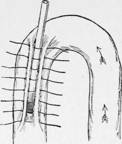 Jejunostomy Operation