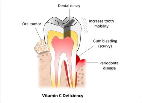 | Vitamin C deficiency and commonly encountered oral lesions ...