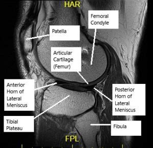 Knee Cartilage Injuries Management - Complete Orthopedics