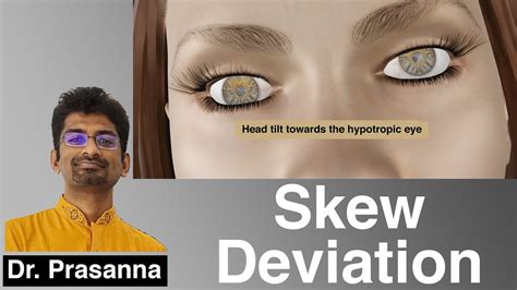 Skew Deviation - YouTube