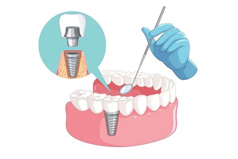 Immediate Dental Implants | A Comprehensive Guide