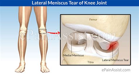 Lateral Meniscus Tear of Knee Joint|Types|Treatment-Conservative, Medications, Surgery