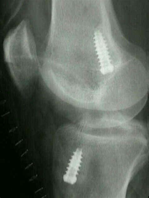 Complications of ACL Reconstructions : Wheeless' Textbook of Orthopaedics