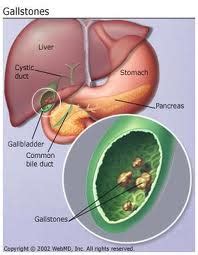 Gallstones Diet | Gallstones Cause & Gallstones After Gallbladder Removal: February 2013