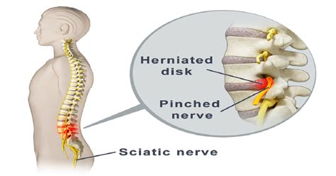 Try These 2 Highly Effective Solutions to Release the Pinched Nerve in the Lumbar Area and ...