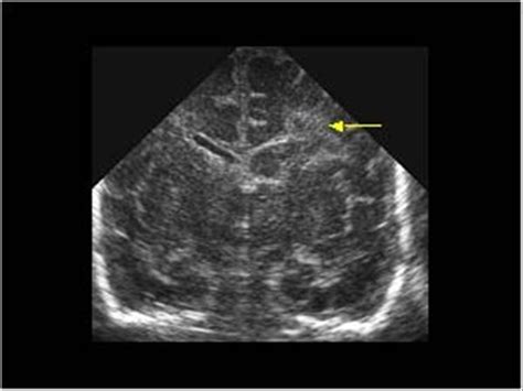 Pediatrics | 9.6 Neonatal brain and spine : Case 9.6.2 Hemorrhage and periventricular cysts ...