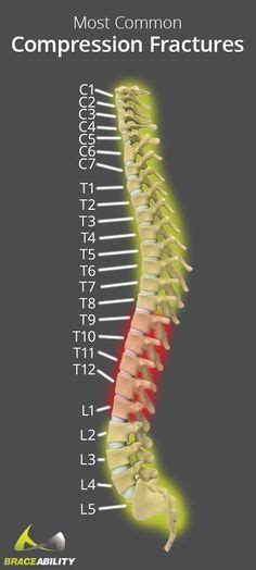 T12 Compression Fracture of Thoracic Spine | Thoracic, Anatomy, Spines