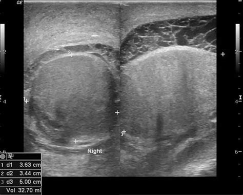 Orchitis - Causes, Symptoms, Diagnosis, Treatment