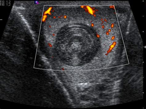 Testicular epidermoid cyst with „onion ring“ appearance | Eurorad