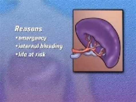 Malpractice Medical Spleen Removal Laparoscopic Splenectomy Surgery 1