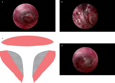 Hysteroscopic metroplasty for a T-shaped uterine cavity. a, b and d are ...