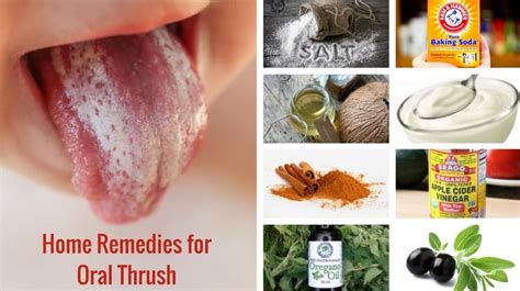 8 Best Home Remedies for Oral Thrush