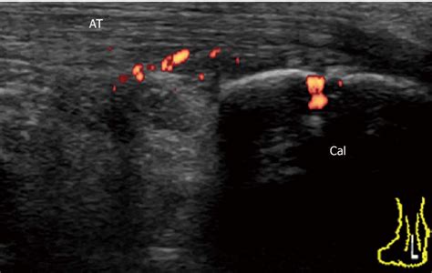 Achilles tendon enthesitis in early undifferentiated spondyloarthritis... | Download Scientific ...