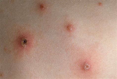 Pin on Chicken Pox