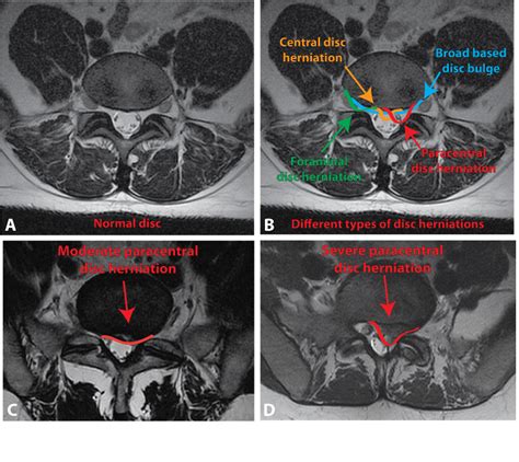 Healthcare Extreme How To Read An MRI Lumbar Spine In 8 Easy Steps ...