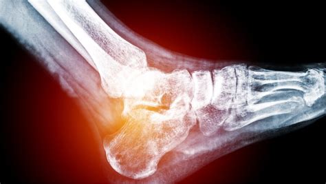 Gout in Heel: Causes, Signs and Treatment