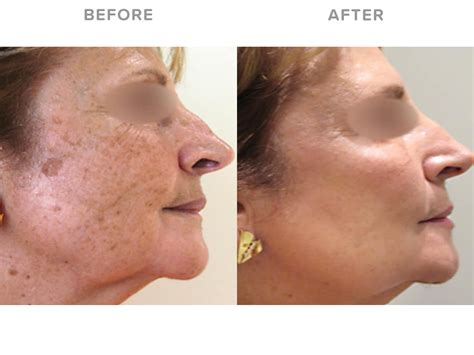 Pigmentation Removal With Candela GentleLase Pro - Eden Laser Clinics