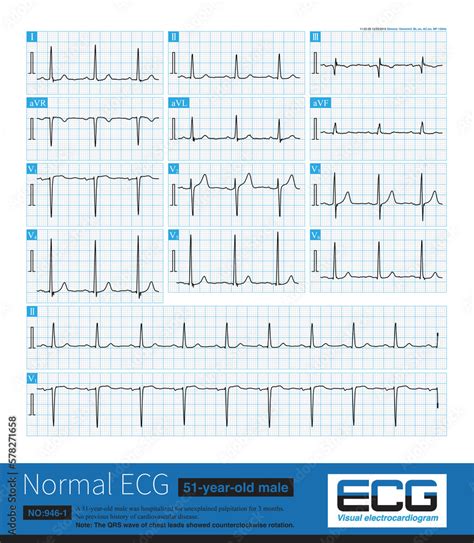 Note that the V3 lead of this ECG shows that the amplitude of R wave is greater than the ...