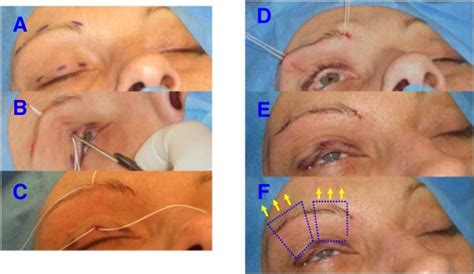 Frontalis suspension surgery to treat patients with essential ...