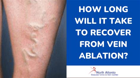 How Long Will It Take to Recover From Vein Ablation?