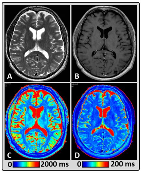 Ms Brain Mri With Contrast