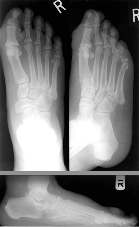 Current Insights On Treating Graves’ Dermopathy In The Foot