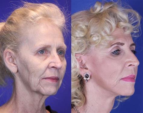 Facelift / Reflection Lift Before & After Photo Gallery | Brentwood, TN | Youthful Reflections ...
