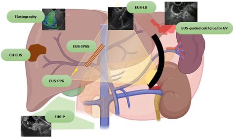 Endoscopic Ultrasound-guided Vascular Interventions: An, 47% OFF