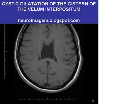 Cavum Velum Interpositum Cyst