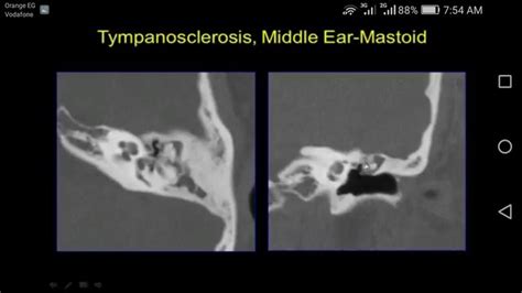 Tympanosclerosis | Middle ear, Ear, Radiology