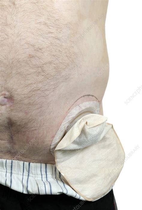 Colostomy - Stock Image - C010/6659 - Science Photo Library